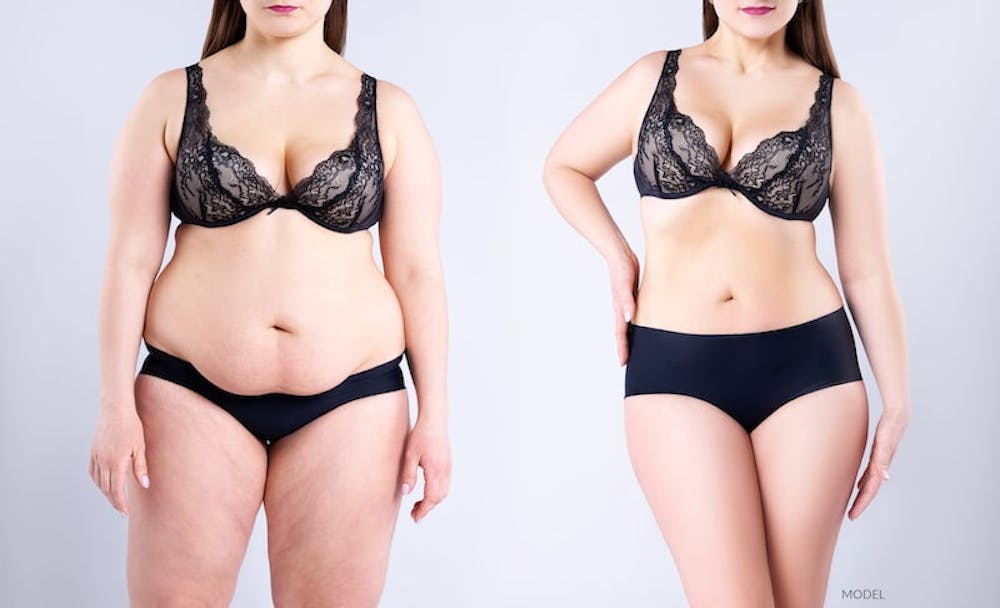 woman-before-after-weight-loss A woman showing before and after weight loss or body contouring.