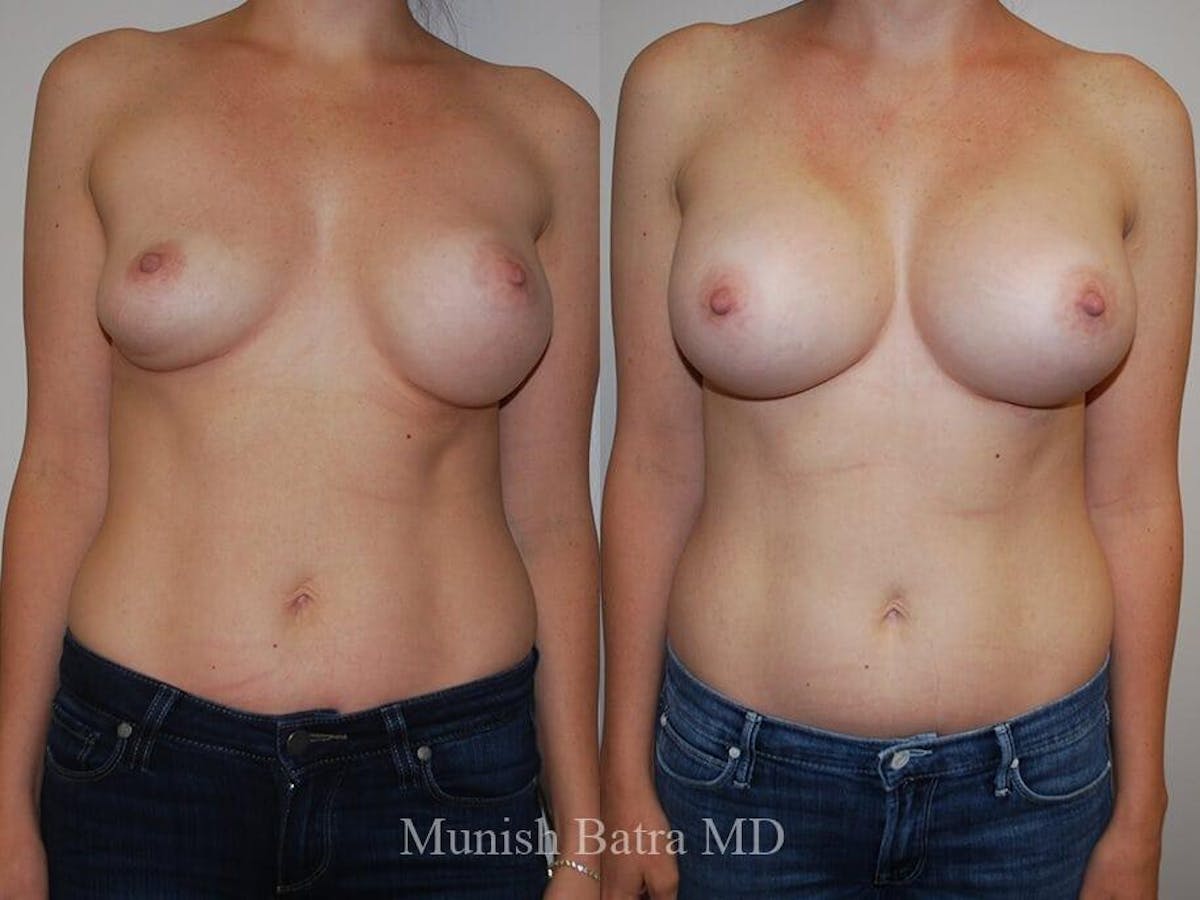 Complex Breast Before & After Gallery - Patient 148151 - Image 1