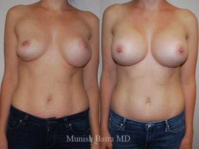 Complex Breast Before & After Gallery - Patient 148151 - Image 1