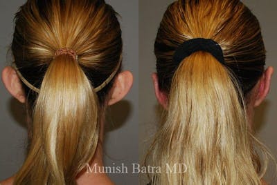 Ear Surgery Before & After Gallery - Patient 366368 - Image 1