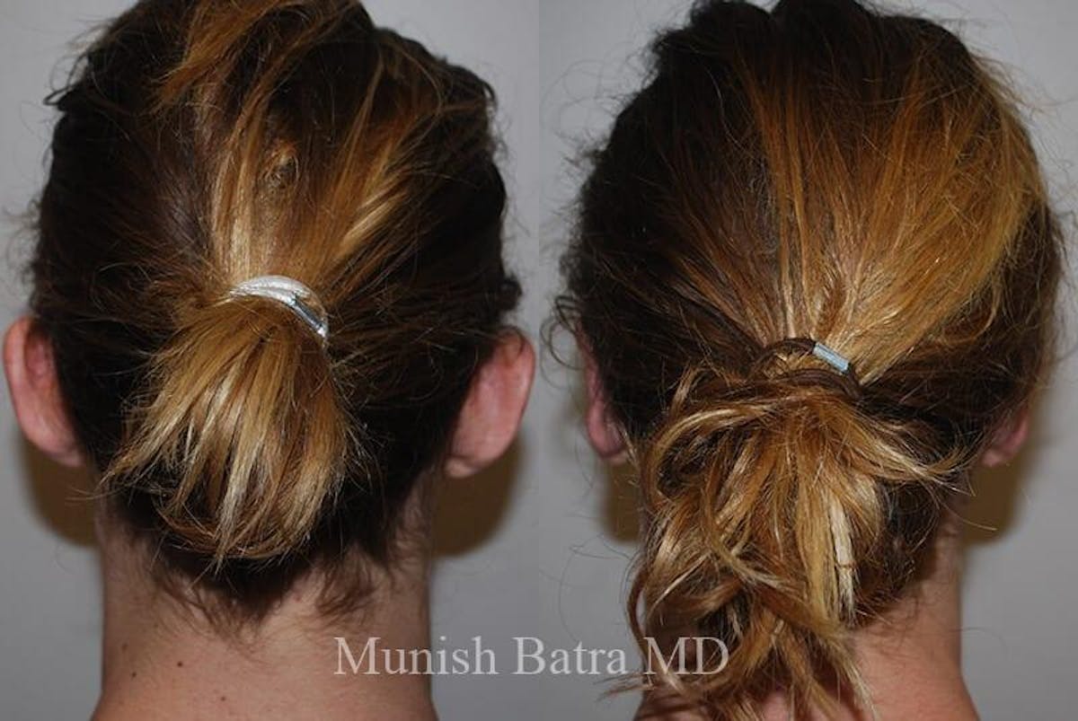 Ear Surgery Before & After Gallery - Patient 391445 - Image 1