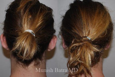 Ear Surgery Before & After Gallery - Patient 391445 - Image 1