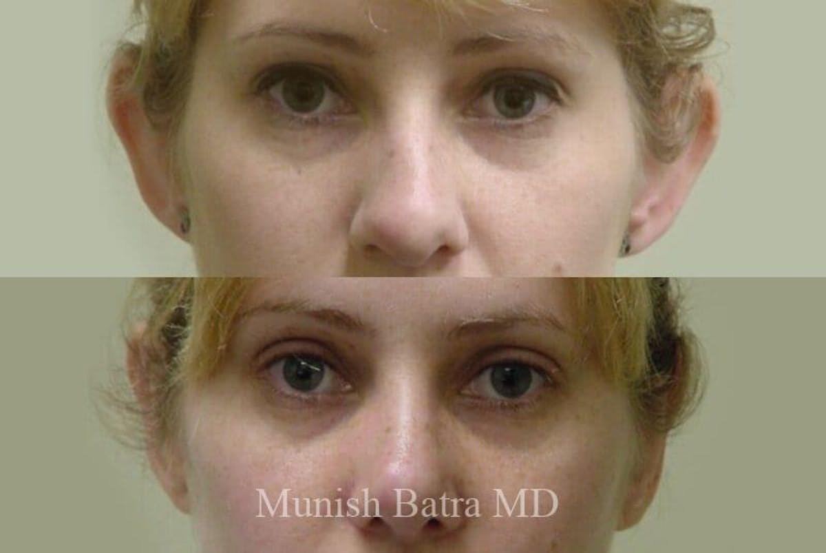 Ear Surgery Before & After Gallery - Patient 345427 - Image 1