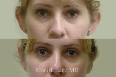 Ear Surgery Before & After Gallery - Patient 345427 - Image 1