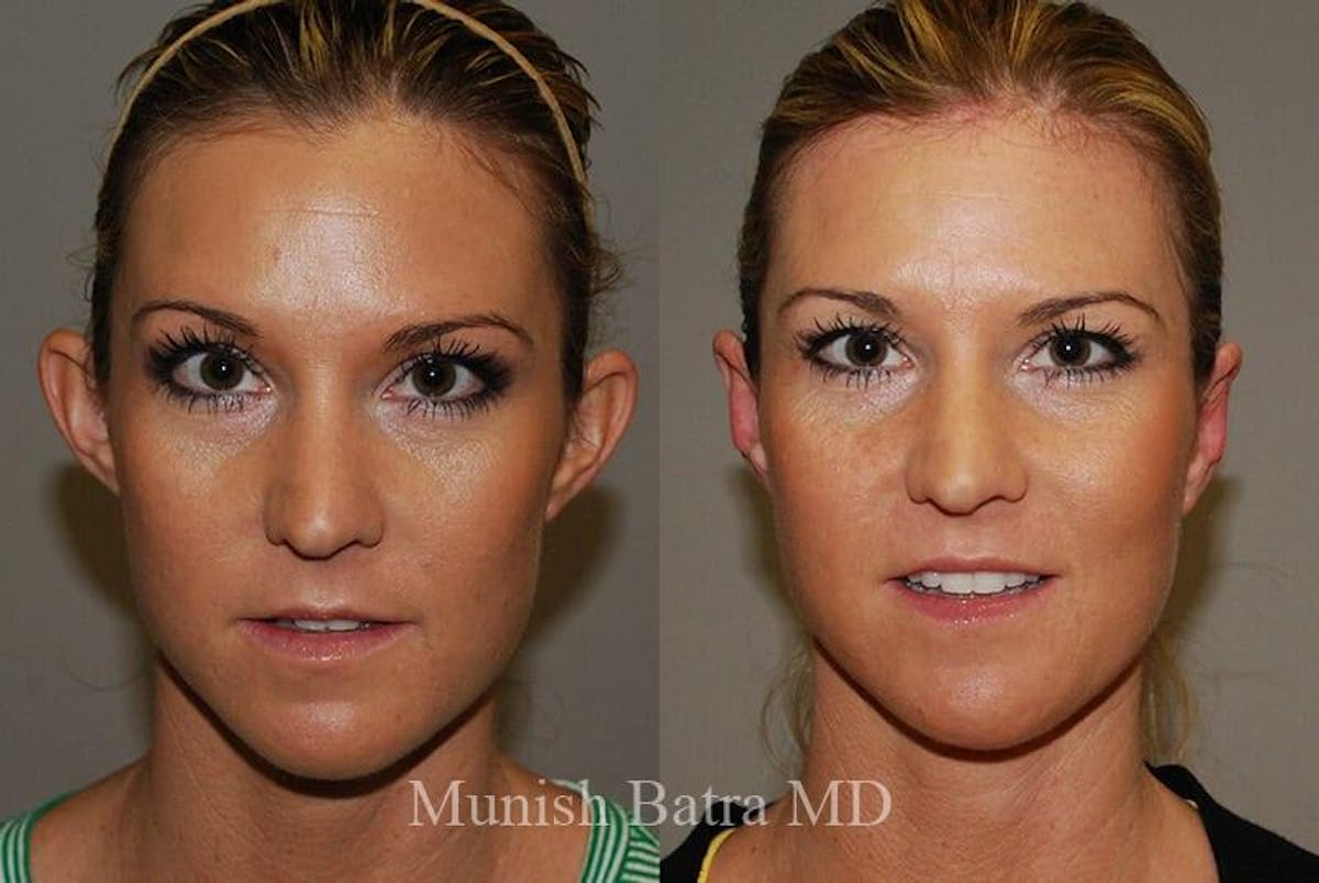 Ear Surgery Before & After Gallery - Patient 236577 - Image 1