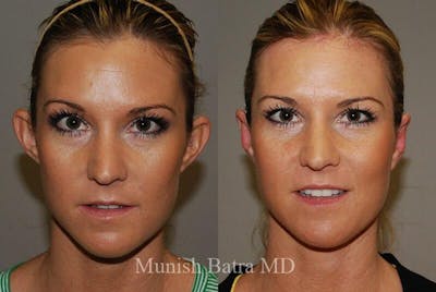 Ear Surgery Before & After Gallery - Patient 236577 - Image 1