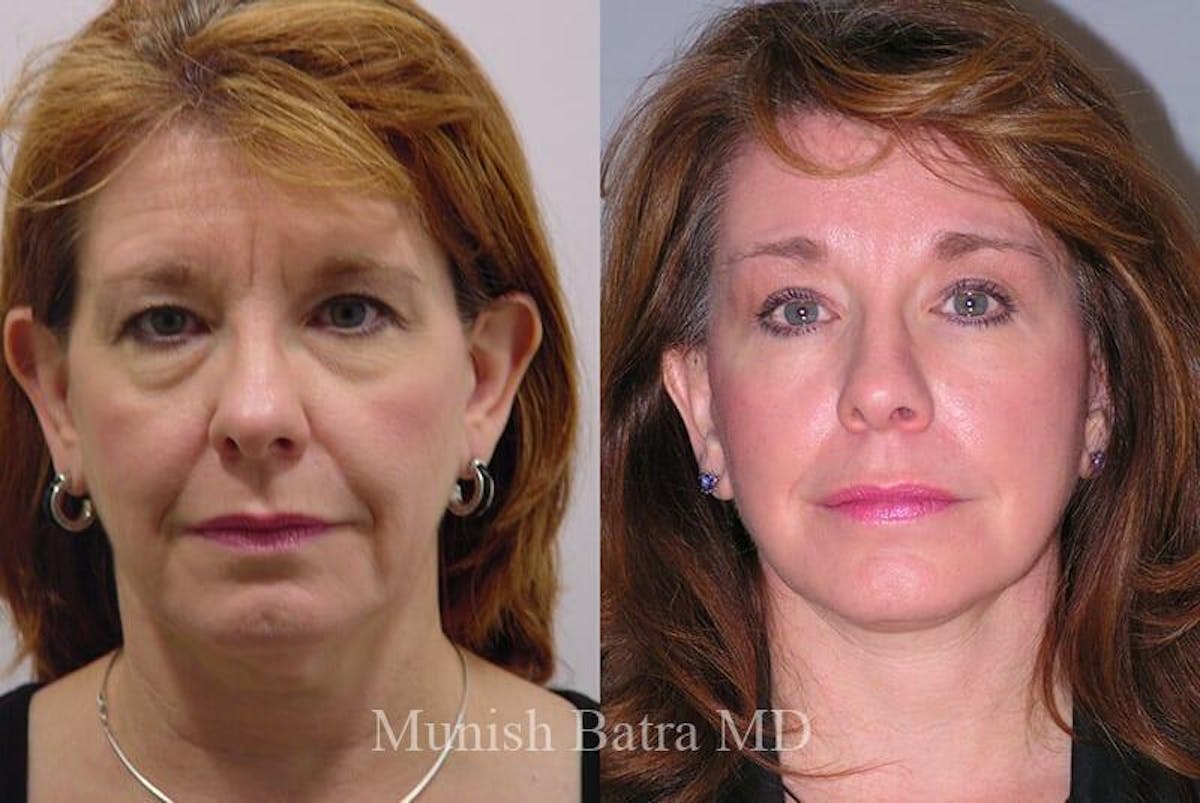 Eyelid Surgery and Brow Lift Before & After Gallery - Patient 283913 - Image 1