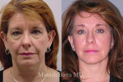Eyelid Surgery and Brow Lift Before & After Gallery - Patient 283913 - Image 1
