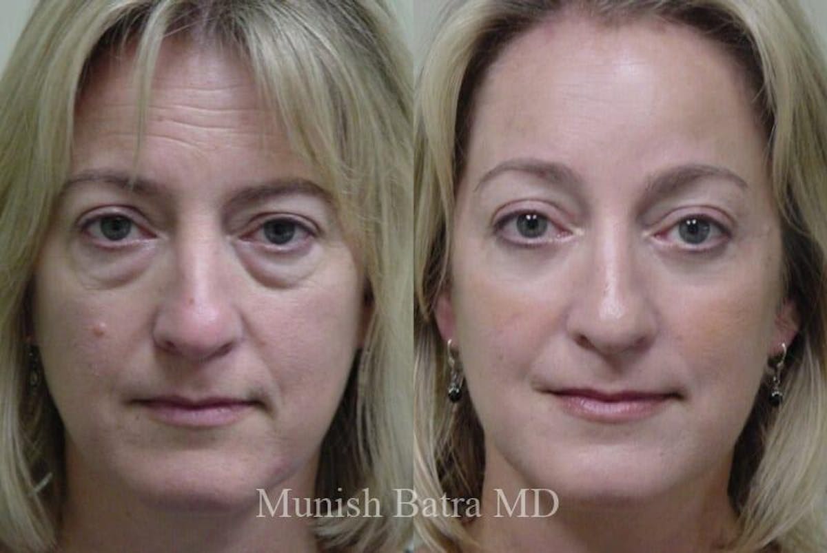 Eyelid Surgery and Brow Lift Before & After Gallery - Patient 304352 - Image 1