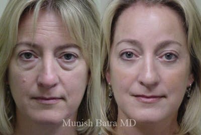 Eyelid Surgery and Brow Lift Before & After Gallery - Patient 304352 - Image 1