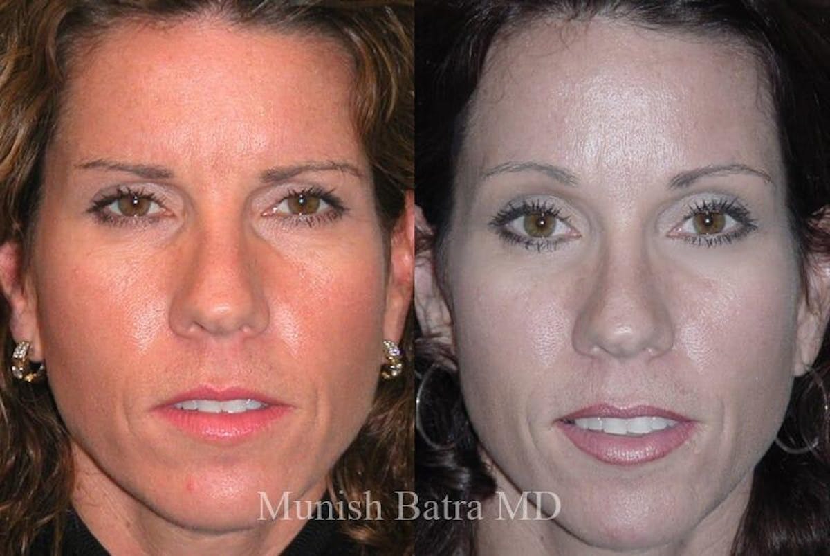 Eyelid Surgery and Brow Lift Before & After Gallery - Patient 412159 - Image 1