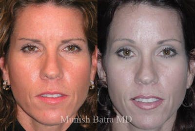 Eyelid Surgery and Brow Lift Before & After Gallery - Patient 412159 - Image 1