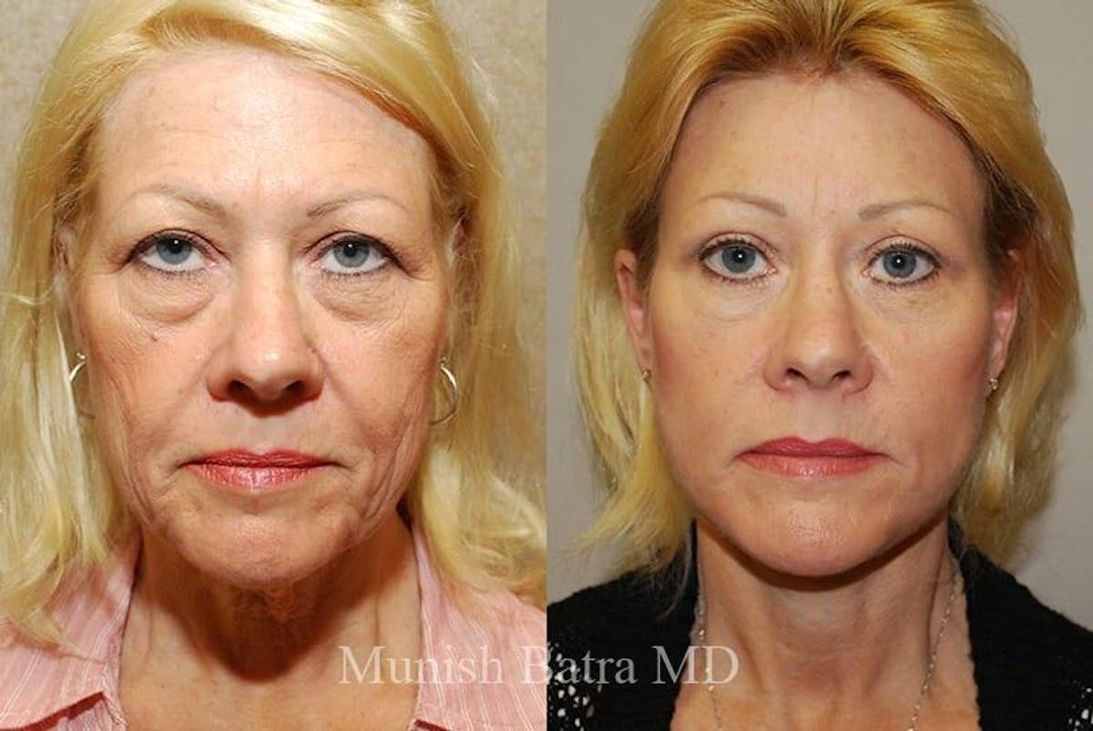 Eyelid Surgery and Brow Lift Before & After Gallery - Patient 376778 - Image 1