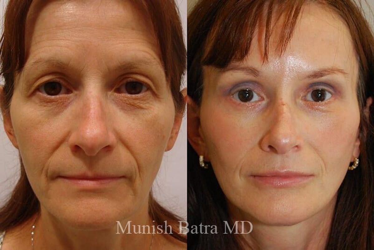 Eyelid Surgery and Brow Lift Before & After Gallery - Patient 336871 - Image 1