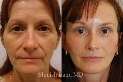 Eyelid Surgery and Brow Lift Before & After Gallery - Patient 336871 - Image 1