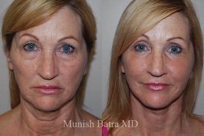 Eyelid Surgery and Brow Lift Before & After Gallery - Patient 366804 - Image 1