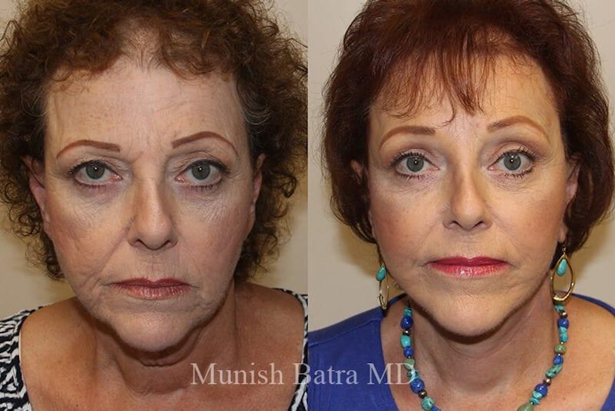 Eyelid Surgery and Brow Lift Before & After Gallery - Patient 236063 - Image 1