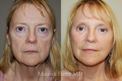 Eyelid Surgery and Brow Lift Before & After Gallery - Patient 333718 - Image 1