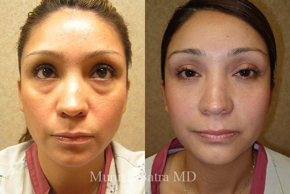 Eyelid Surgery and Brow Lift Before & After Gallery - Patient 782924 - Image 1