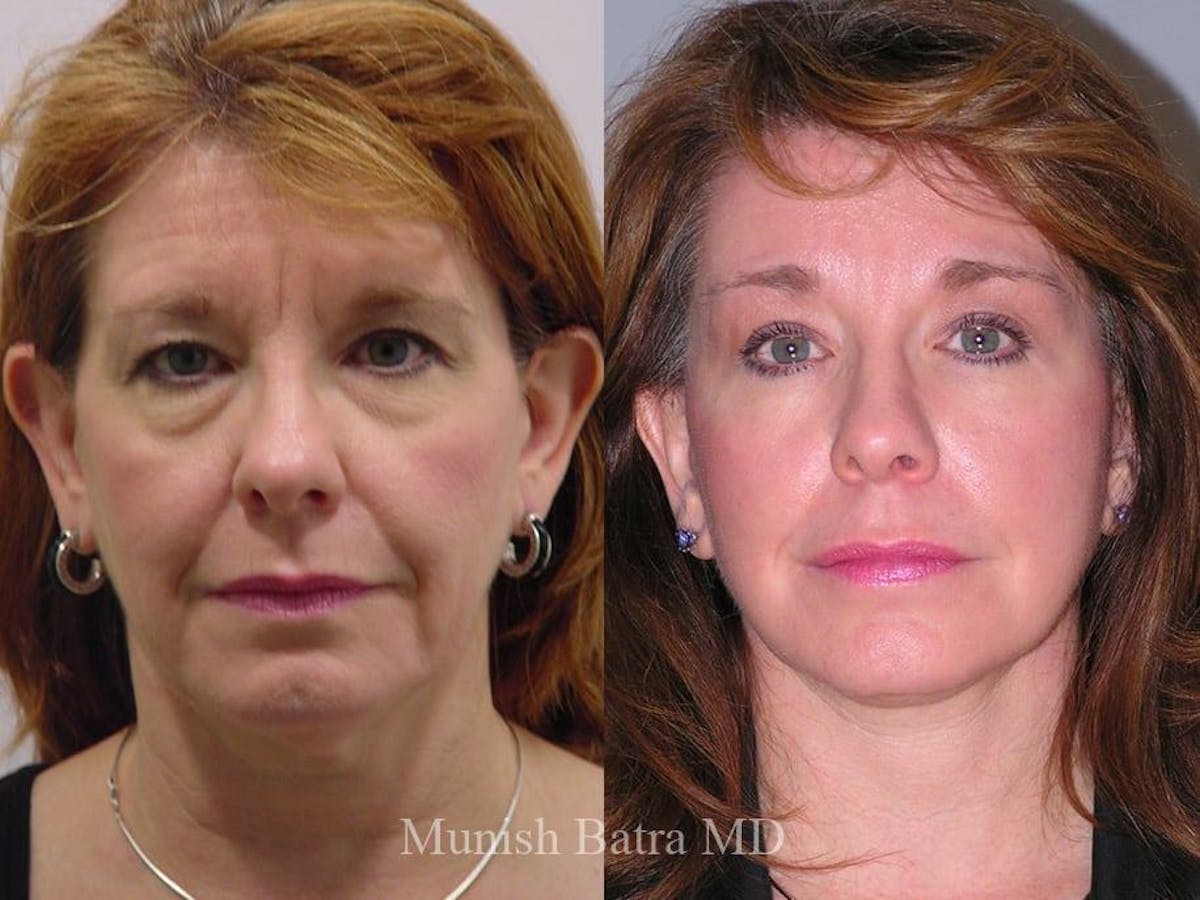 Facelift Before & After Gallery - Patient 213290 - Image 1