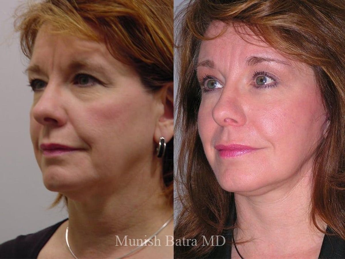 Facelift Before & After Gallery - Patient 213290 - Image 2