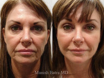 Facelift Before & After Gallery - Patient 631548 - Image 1