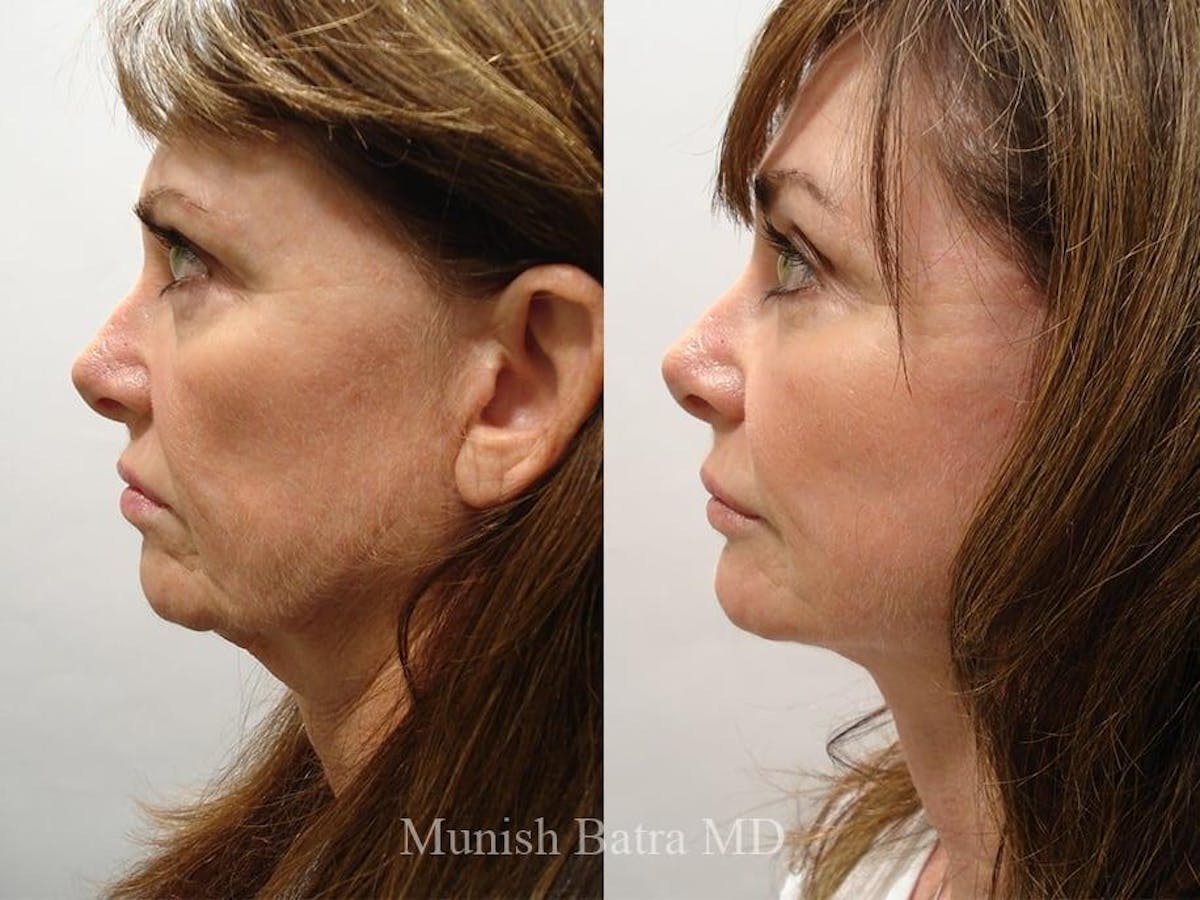Facelift Before & After Gallery - Patient 631548 - Image 2
