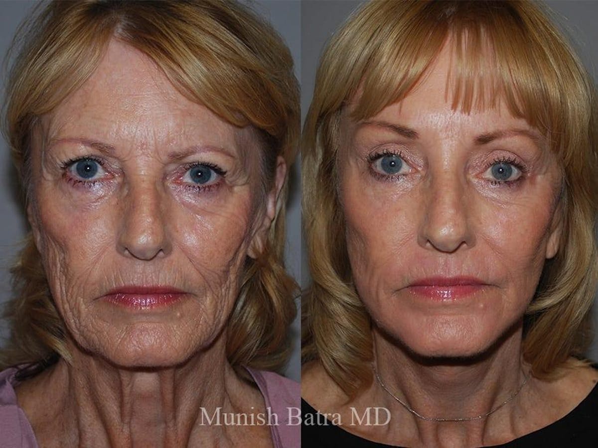 Facelift Before & After Gallery - Patient 189078 - Image 1