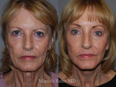 Facelift Before & After Gallery - Patient 189078 - Image 1