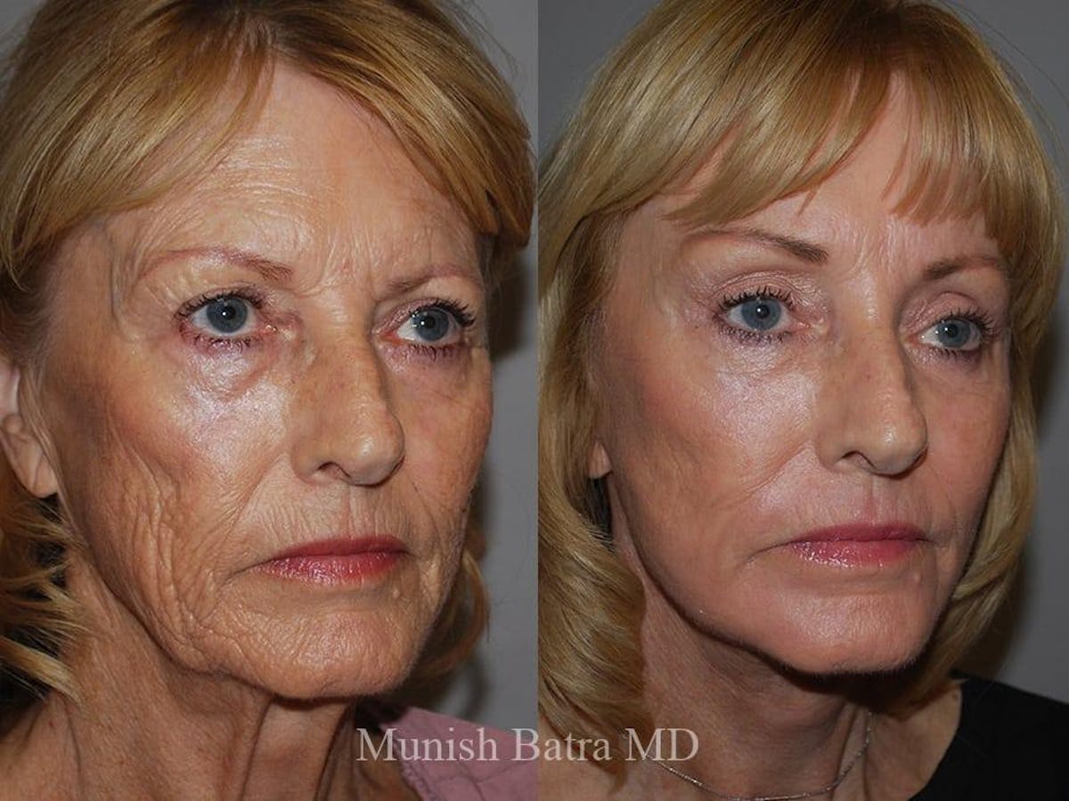Facelift Before & After Gallery - Patient 189078 - Image 2