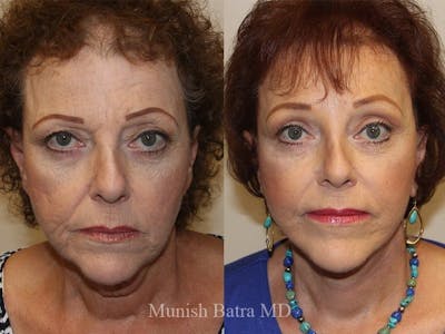Facelift Before & After Gallery - Patient 794842 - Image 1