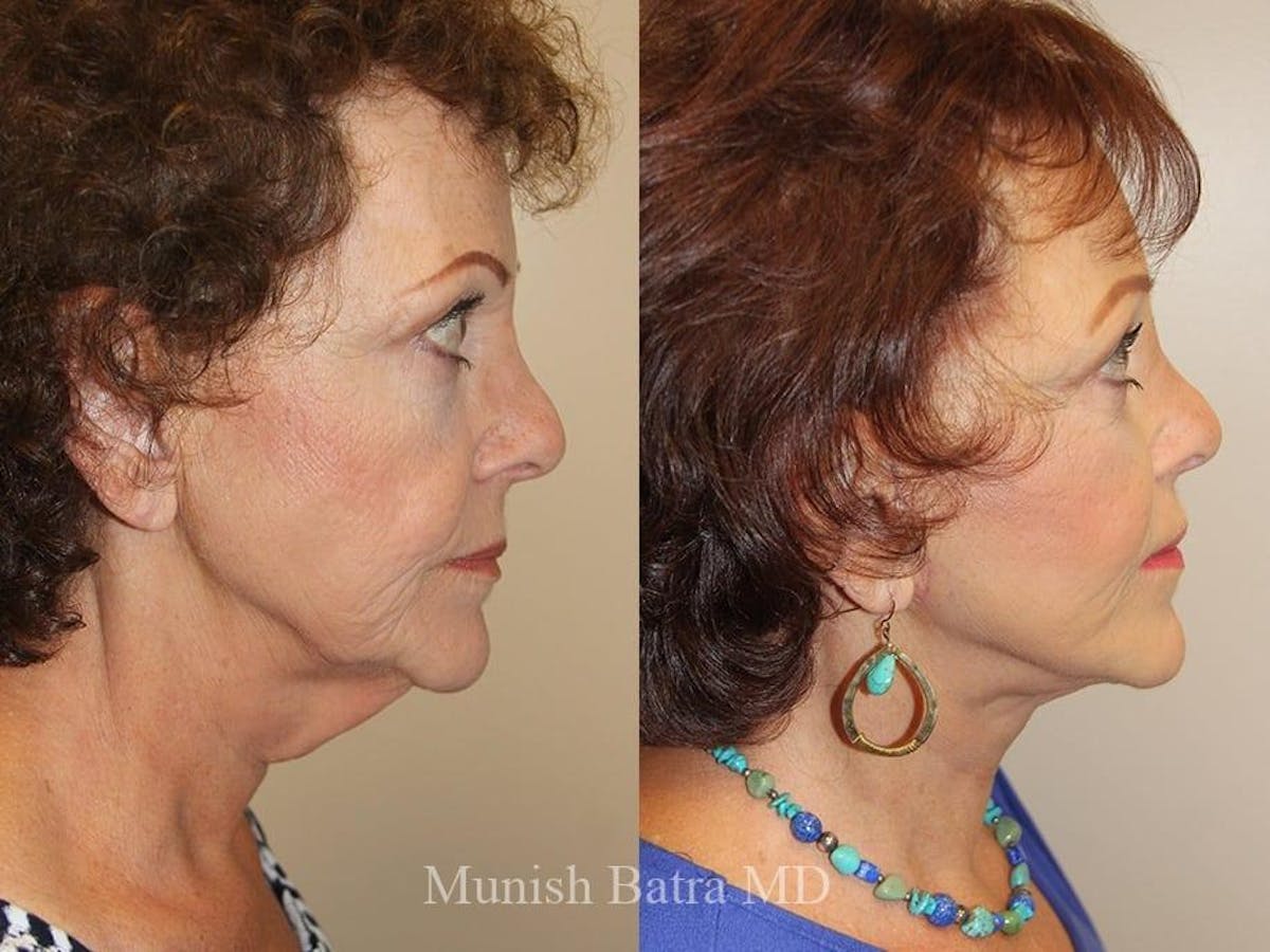 Facelift Before & After Gallery - Patient 794842 - Image 2