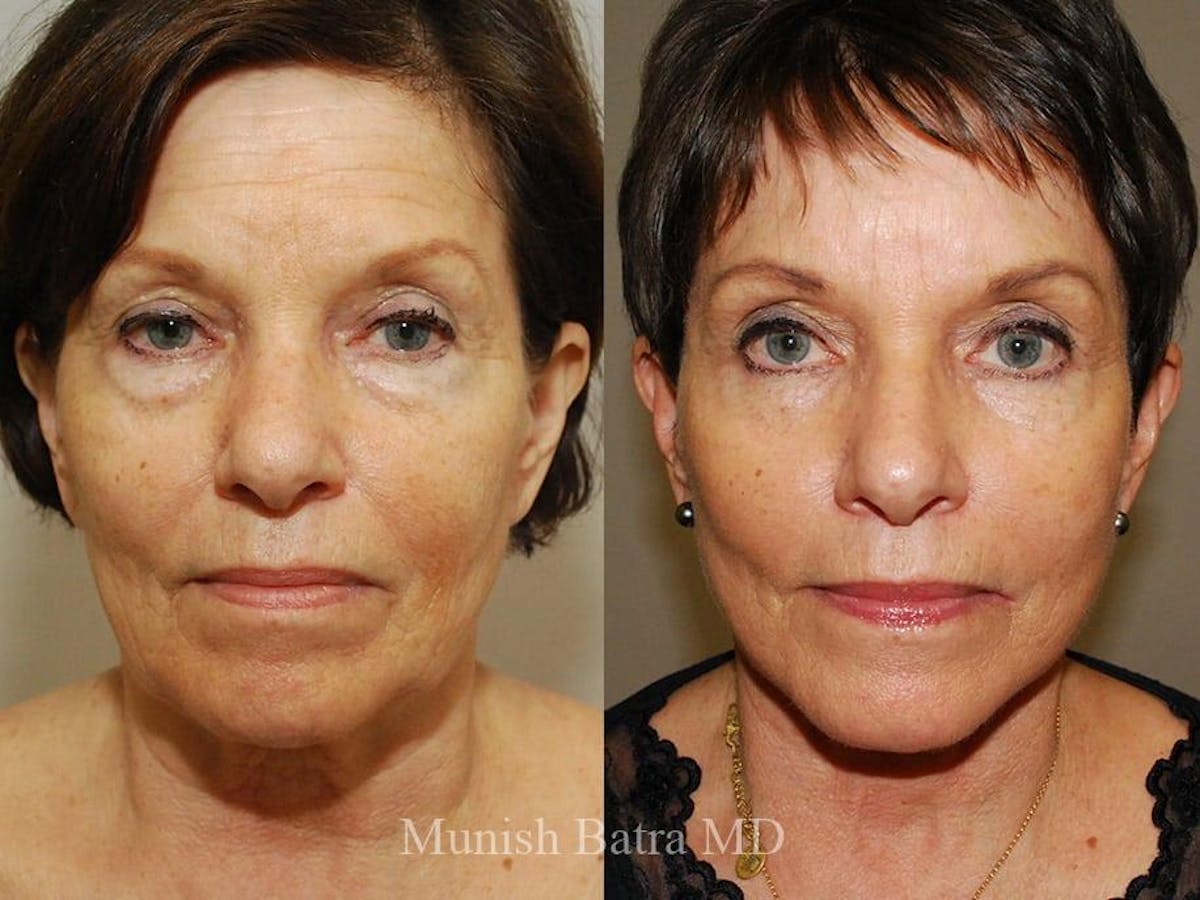 Facelift Before & After Gallery - Patient 390942 - Image 1