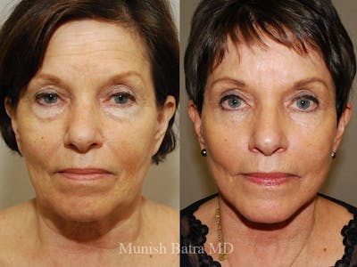 Facelift Before & After Gallery - Patient 390942 - Image 1