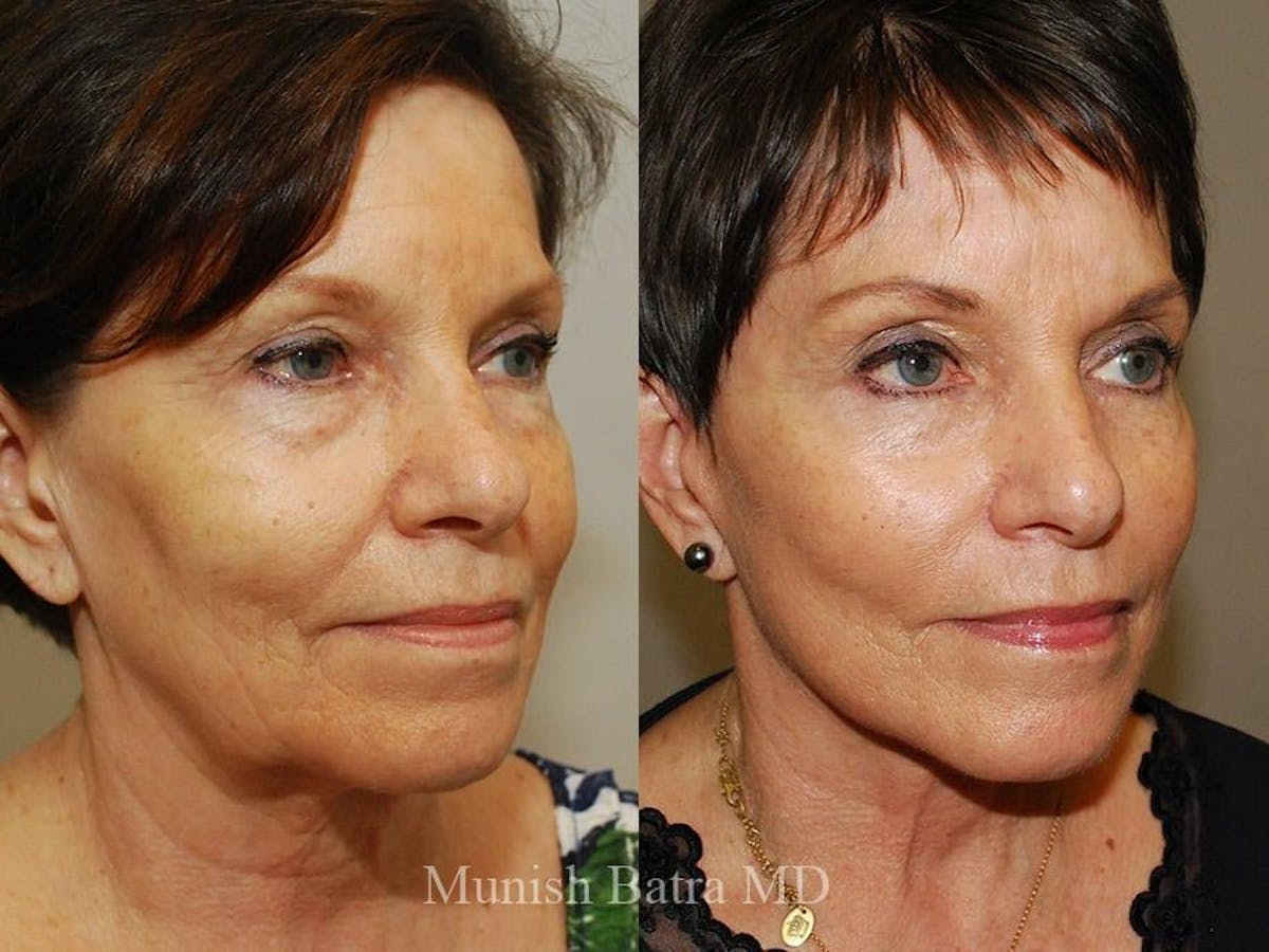 Facelift Before & After Gallery - Patient 390942 - Image 2