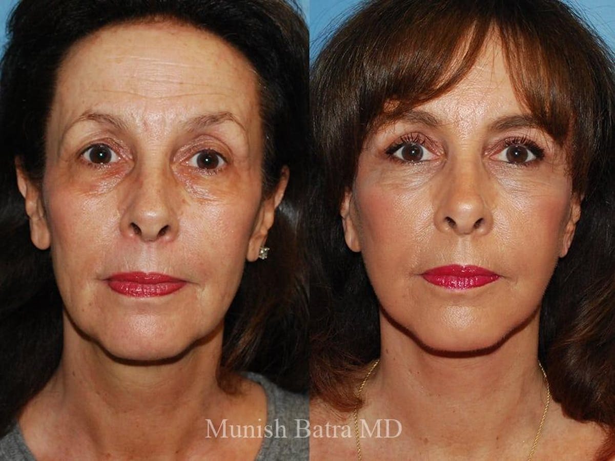 Facelift Before & After Gallery - Patient 267161 - Image 1
