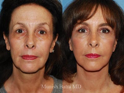 Facelift Before & After Gallery - Patient 267161 - Image 1