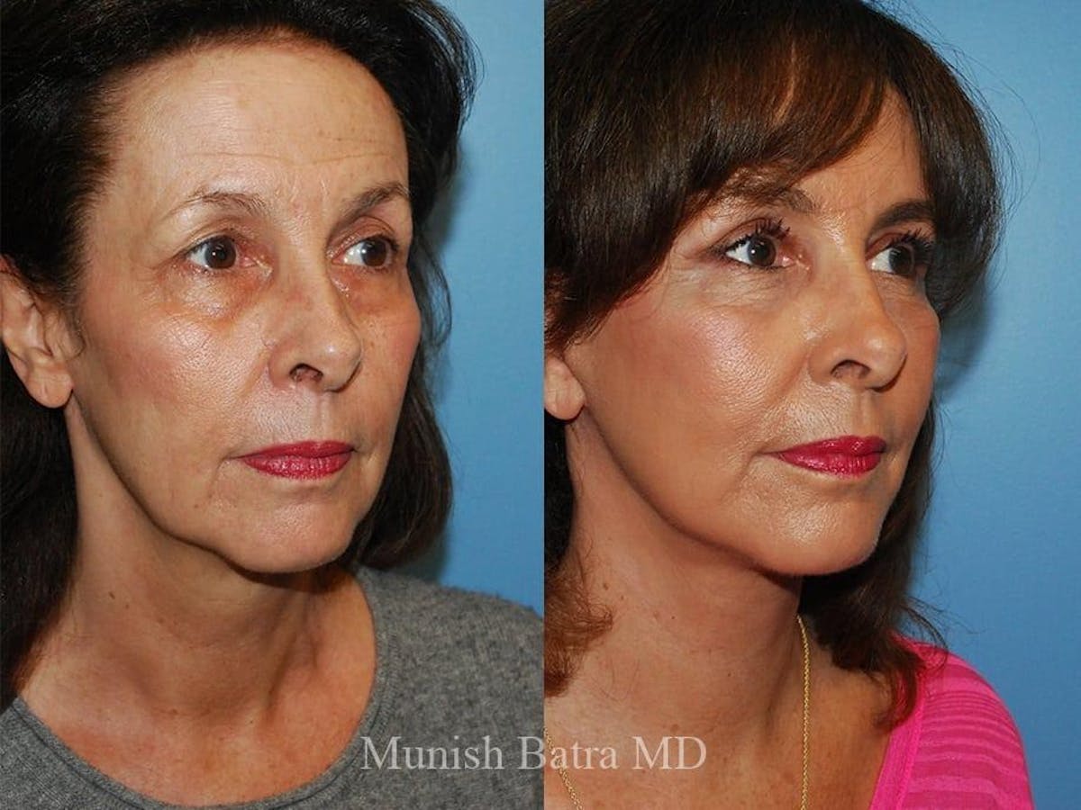 Facelift Before & After Gallery - Patient 267161 - Image 2