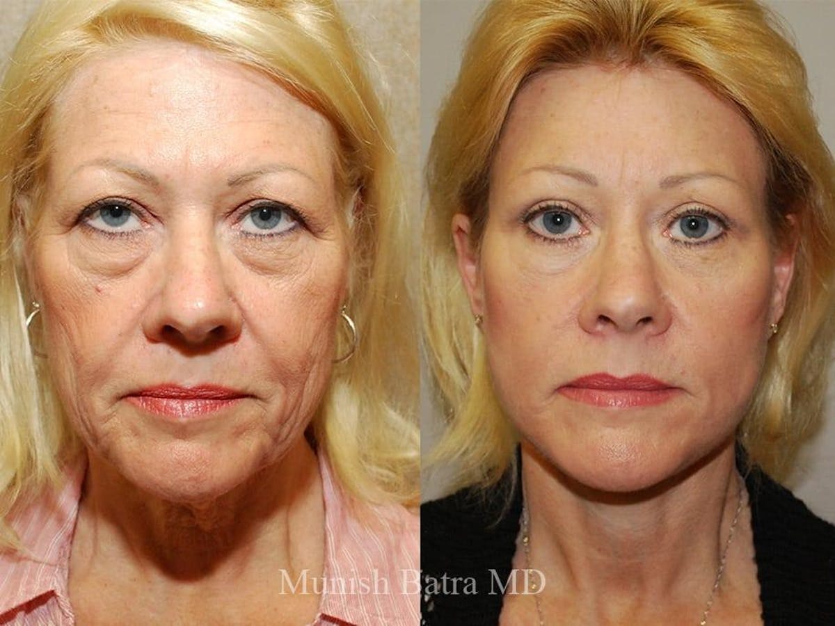 Facelift Before & After Gallery - Patient 313693 - Image 1