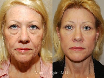 Facelift Before & After Gallery - Patient 313693 - Image 1