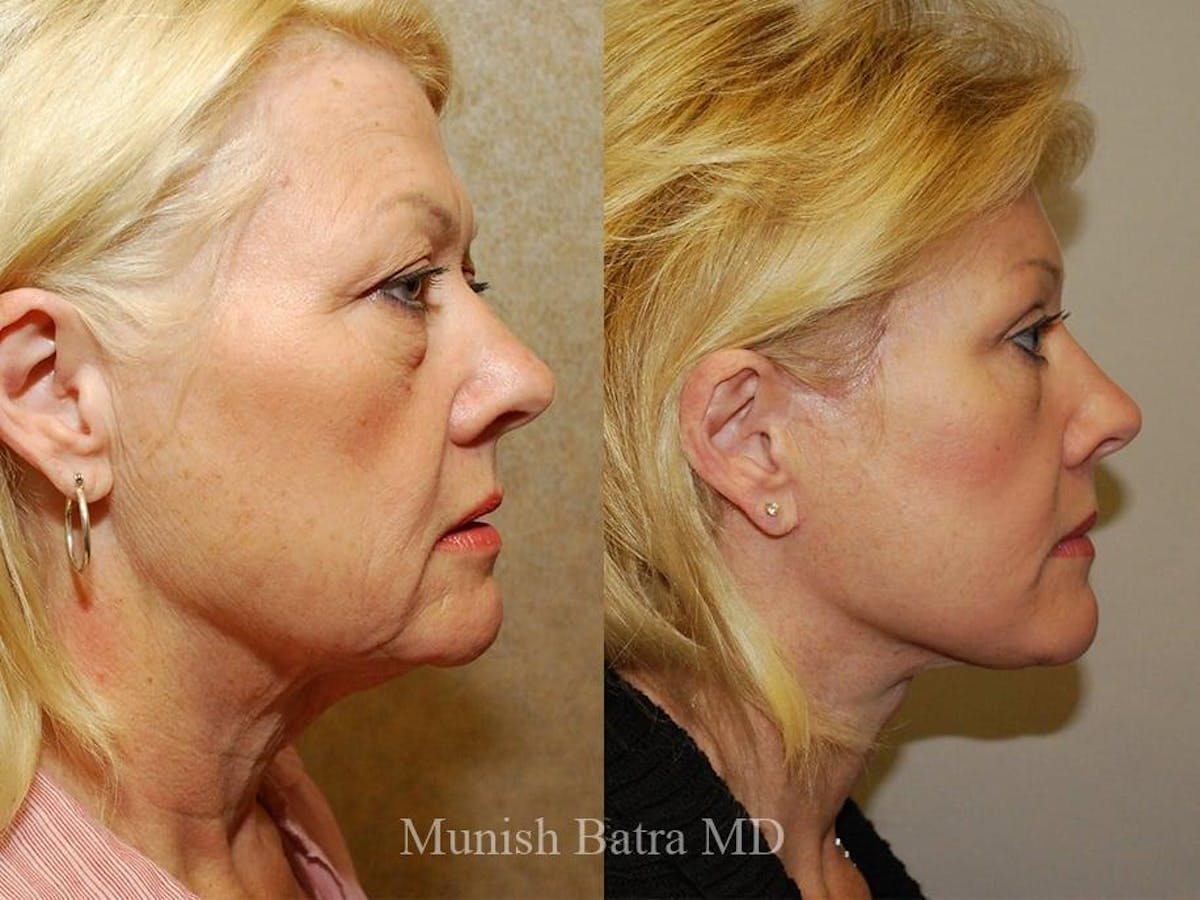 Facelift Before & After Gallery - Patient 313693 - Image 2
