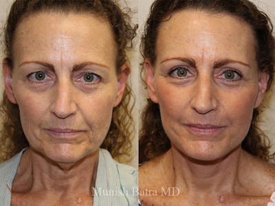 Facelift Before & After Gallery - Patient 305464 - Image 1