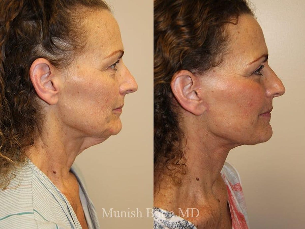 Facelift Before & After Gallery - Patient 305464 - Image 2