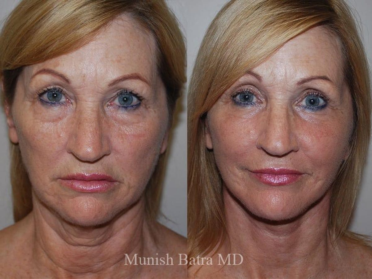 Facelift Before & After Gallery - Patient 235981 - Image 1