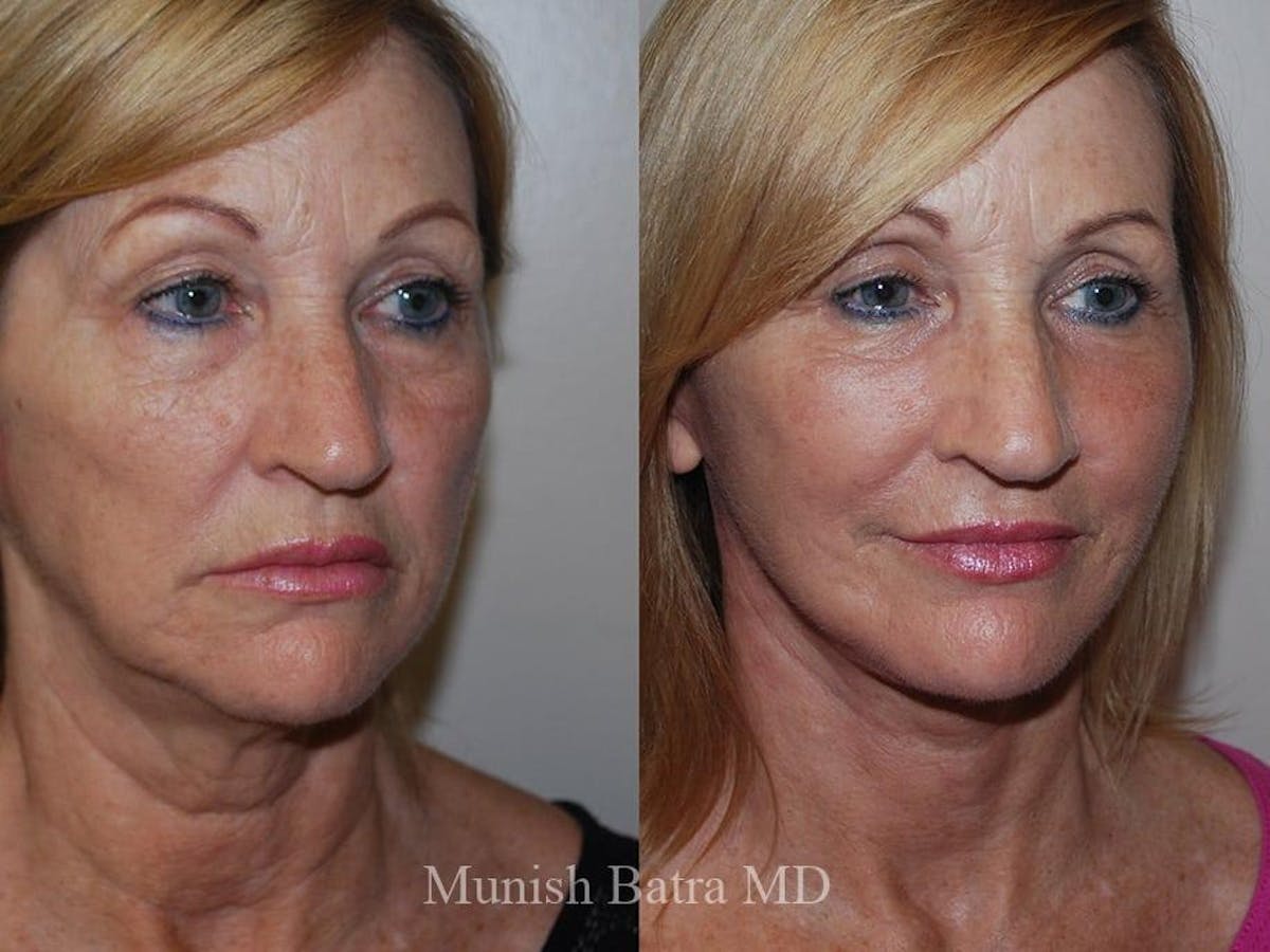 Facelift Before & After Gallery - Patient 235981 - Image 2