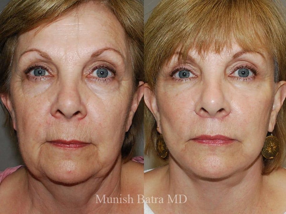 Facelift Before & After Gallery - Patient 244714 - Image 1