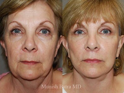 Facelift Before & After Gallery - Patient 244714 - Image 1