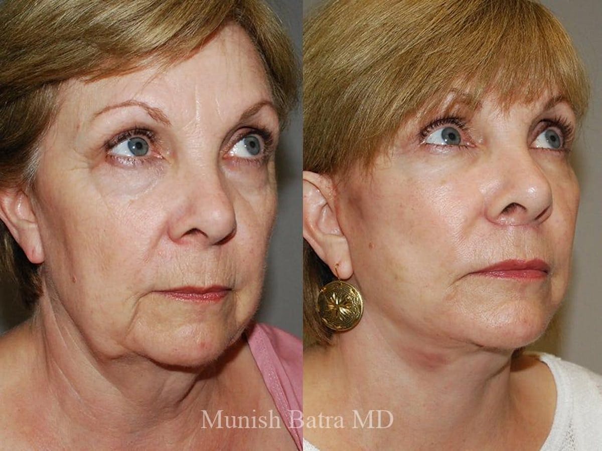 Facelift Before & After Gallery - Patient 244714 - Image 2
