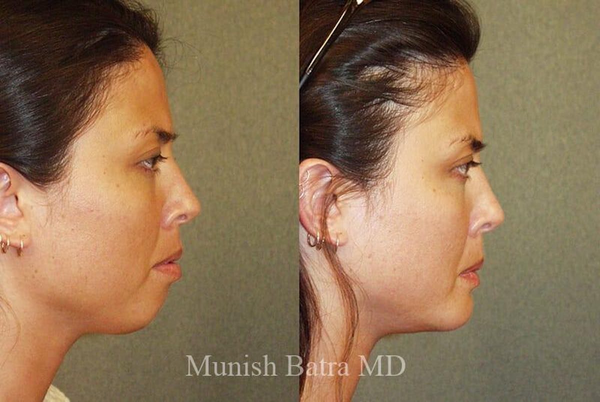 Facial Implant Augmentation Before & After Gallery - Patient 181465 - Image 1