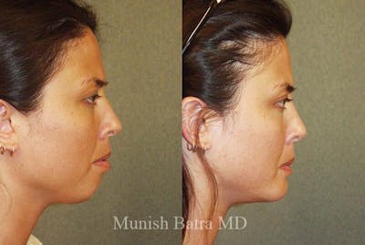 Facial Implant Augmentation Before & After Gallery - Patient 181465 - Image 1